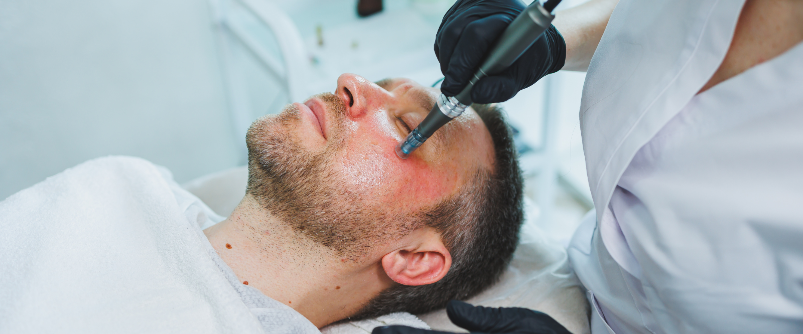 Acne Scar Treatment in Mira Road