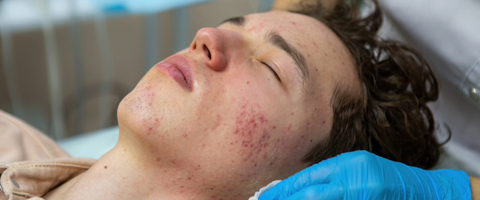 Acne Treatment in Mira Road