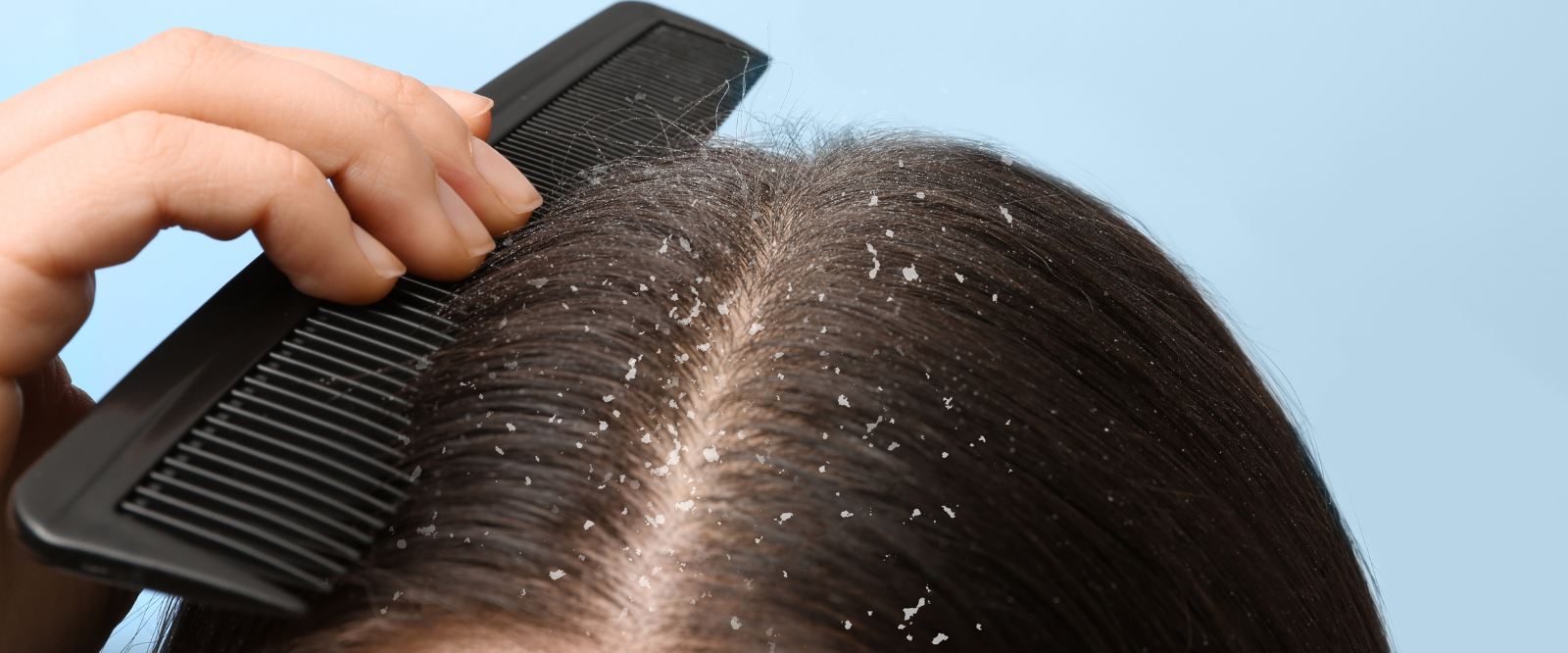 Dandruff Treatment in Mira Road