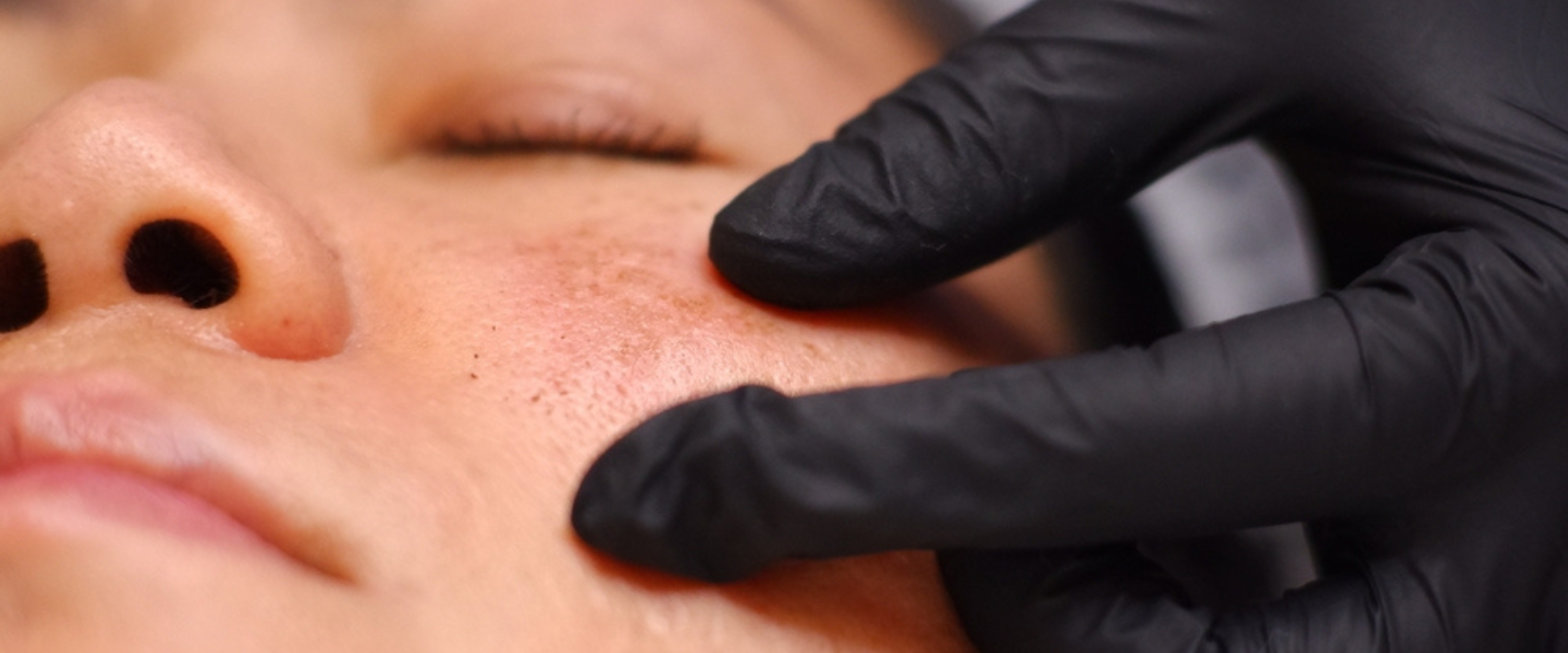 Melasma Treatment in Mira Road