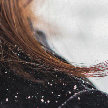 winter dandruff care