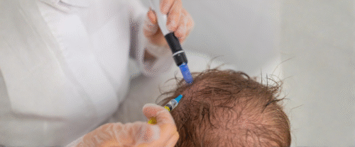 GFC Therapy for Hair Regrowth in Mira Road