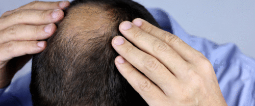 Hair Loss Treatment in Mira Road