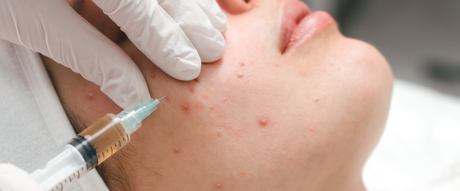 Face Acne Treatment in Mira Road