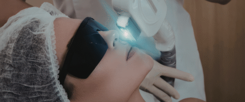 Q Switch Laser Treatment in Mira Road