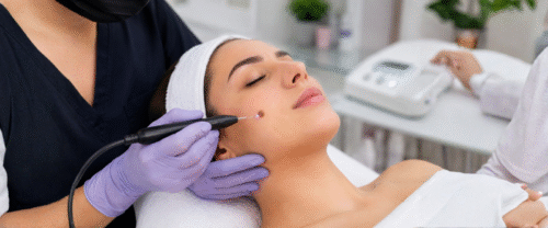 RF Cautery Removal Treatment in Mira Road