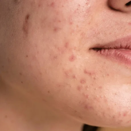 Acne Scars