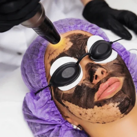 Carbon Laser Treatments