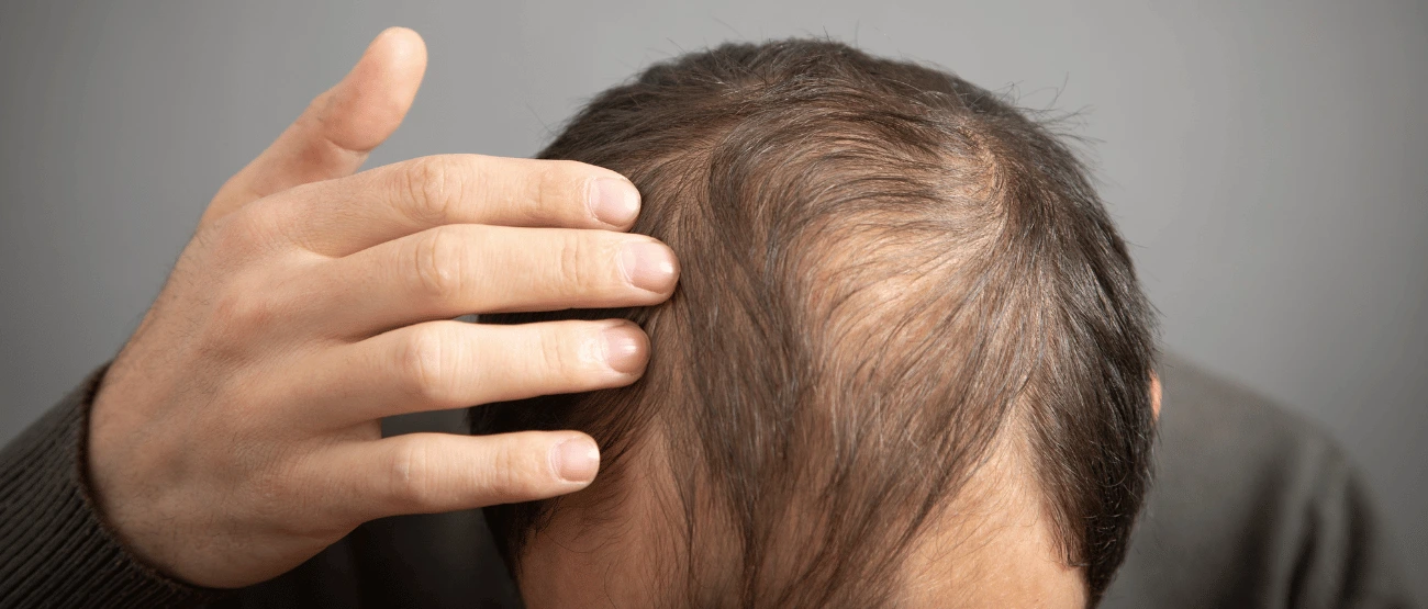 Treatments for Early Hair Loss